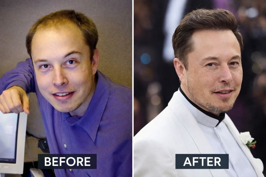 Elon Musk Hair Replacement System
